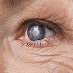 eye with cataract