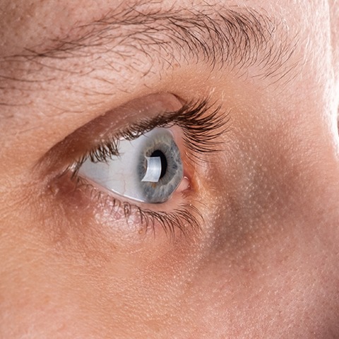 keratoconus-large keratoconus-large