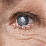 cataract-small